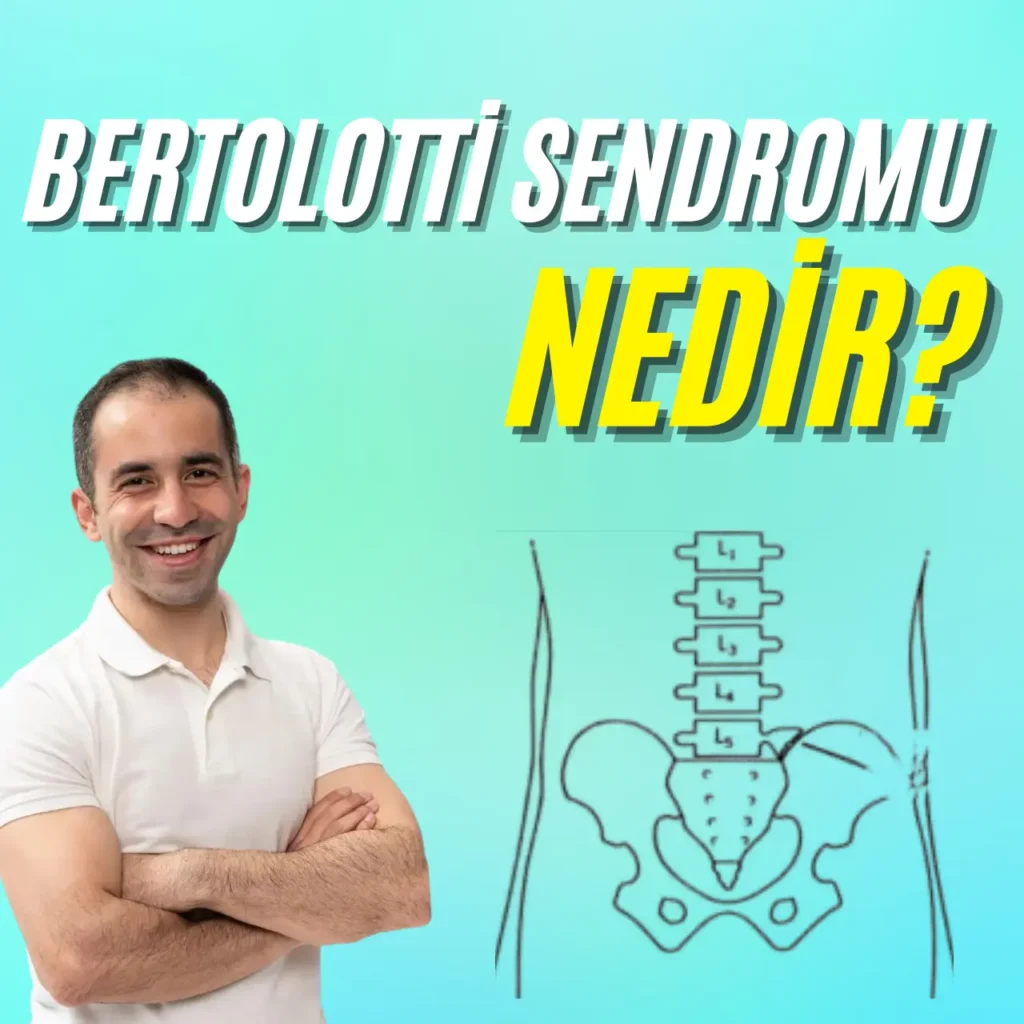 bertolotti sendromu