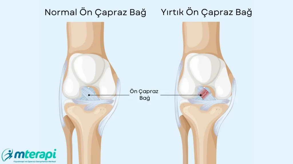 Ön Çapraz Bağ Ameliyatı Sonrası Spora Dönüş ön çapraz bağ