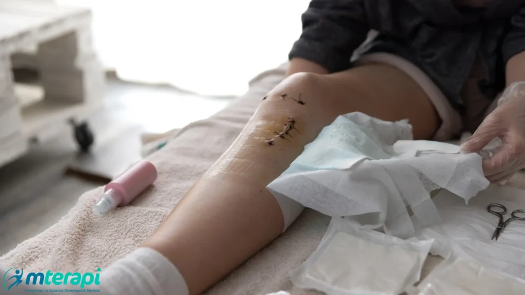 Ön Çapraz Bağ Ameliyatı Sonrası Spora Dönüş ön çapraz bağ ameliyatı sonrası