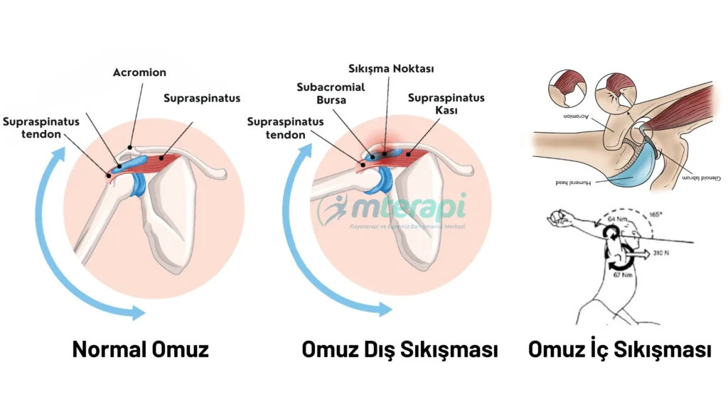 omuz sıkışma sendromu türleri 