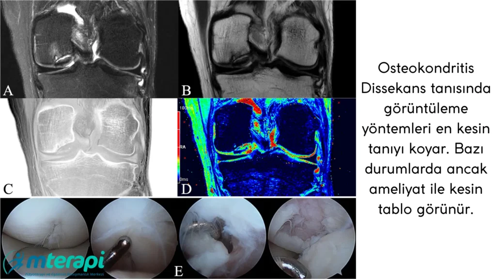 osteokondritis dissekans