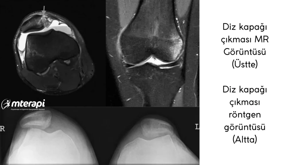 diz kapağı çıkması röntgen