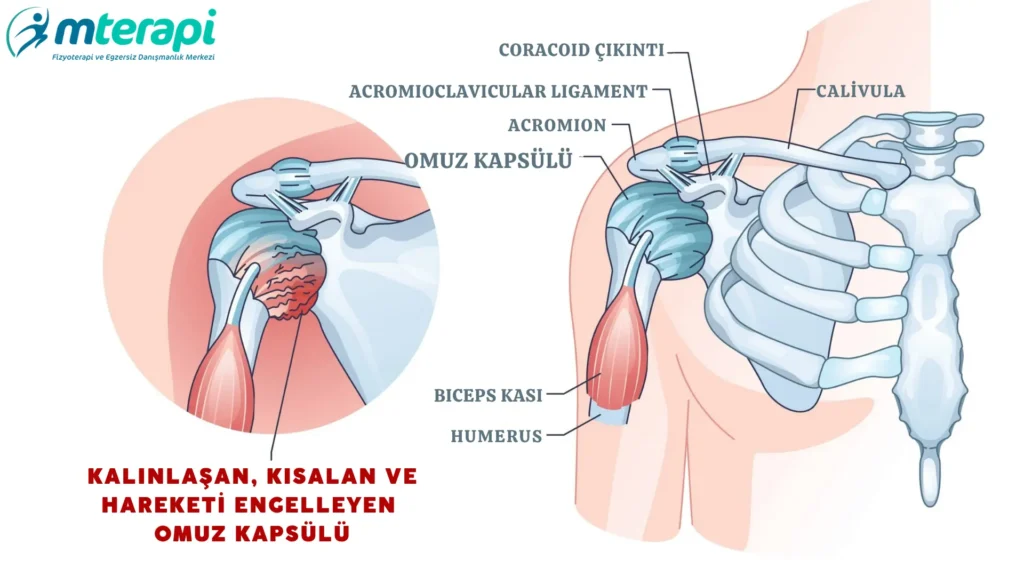 donuk omuz neden olur