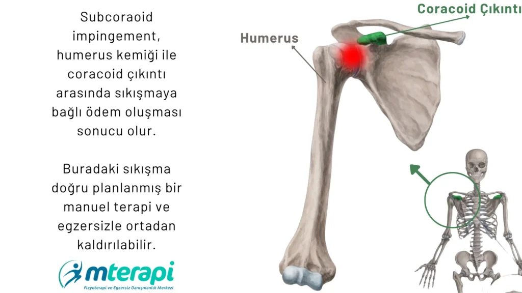 subcoracoid impingement
