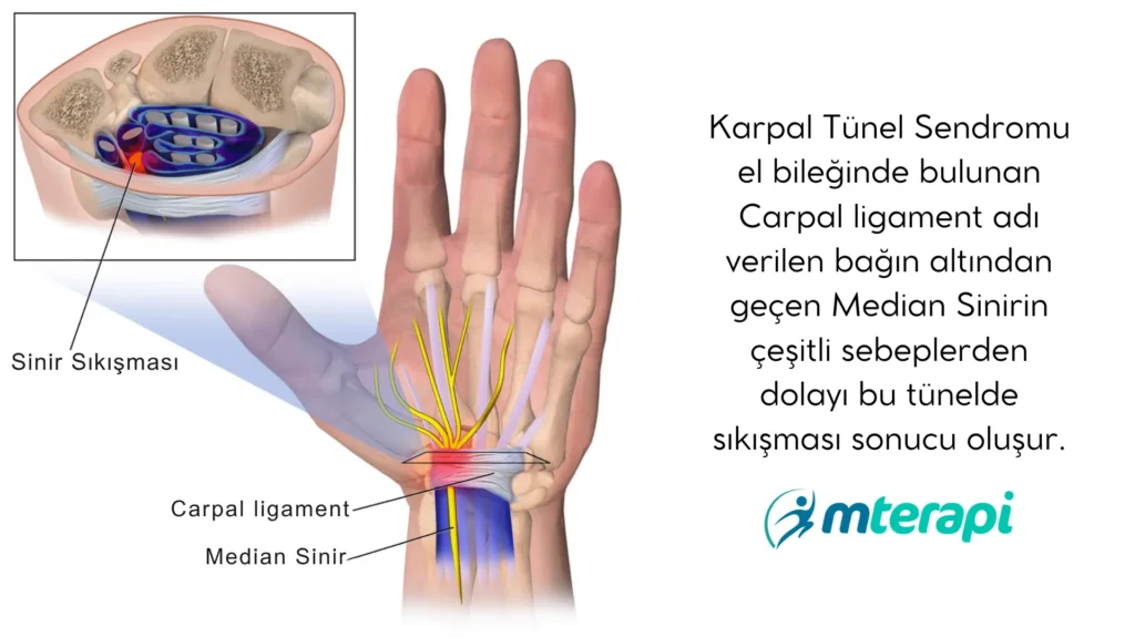 karpal tünel sendromu neden olur
